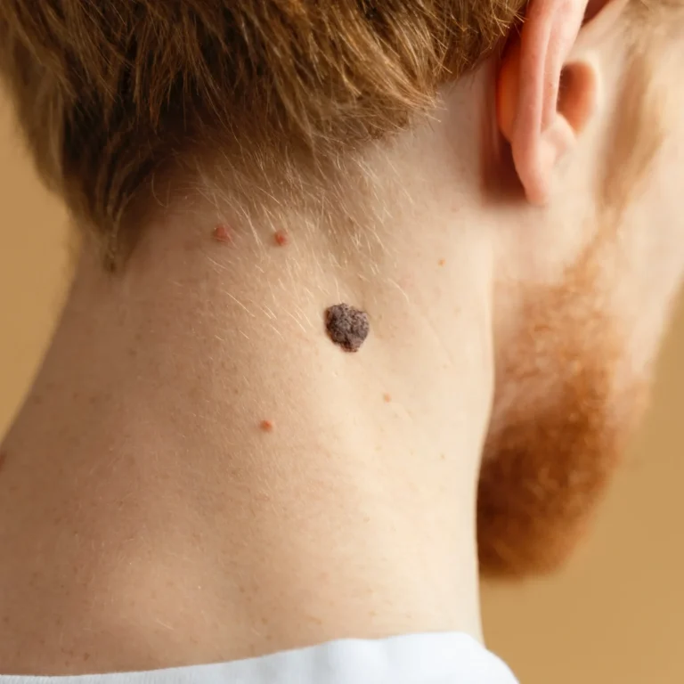 close-up-young-man-with-mole-neck