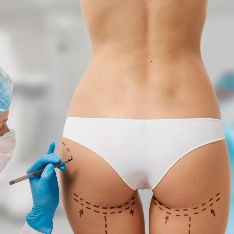 woman-marked-out-cosmetic-surgery