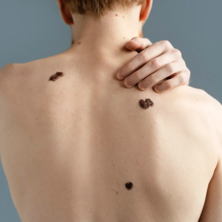 young-man-with-melanoma-back-view